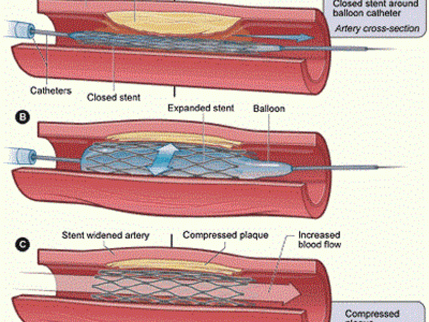 Le stent : comment ça marche ? Le stent : comment ça marche ?