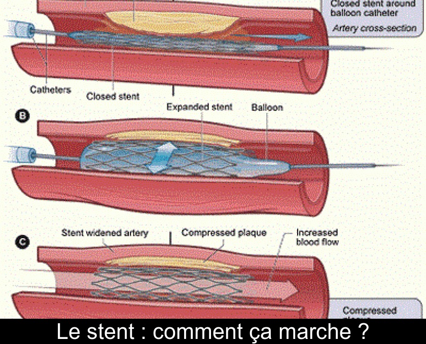 Le stent : comment ça marche ? Le stent : comment ça marche ?