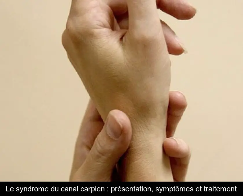 Le syndrome du canal carpien : présentation, symptômes et traitement