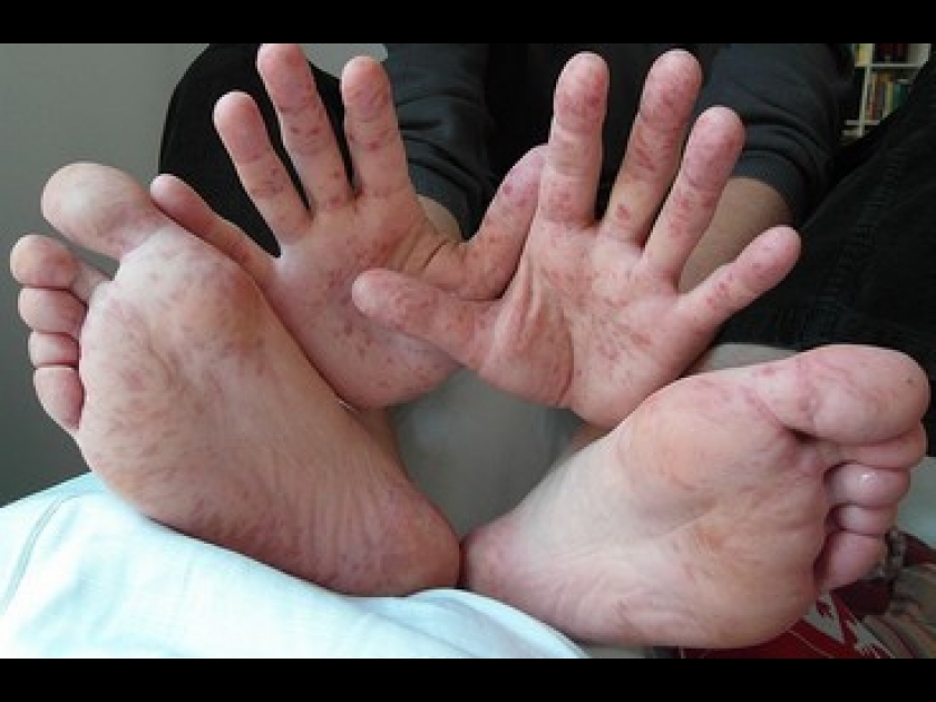 pied main bouche grossesse pied main bouche grossesse