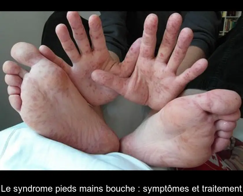 Le syndrome pieds mains bouche : symptômes et traitement