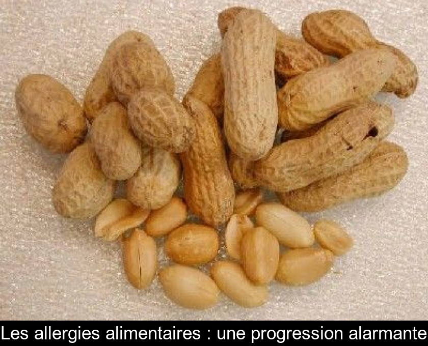 Les allergies alimentaires : une progression alarmante Les allergies alimentaires : une progression alarmante