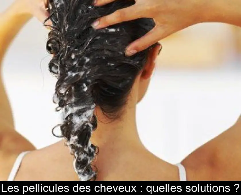 Les pellicules des cheveux : quelles solutions ?