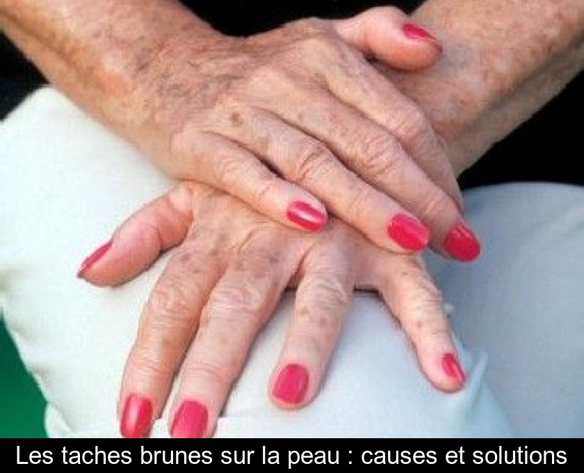 Les taches brunes sur la peau : causes et solutions Les taches brunes sur la peau : causes et solutions