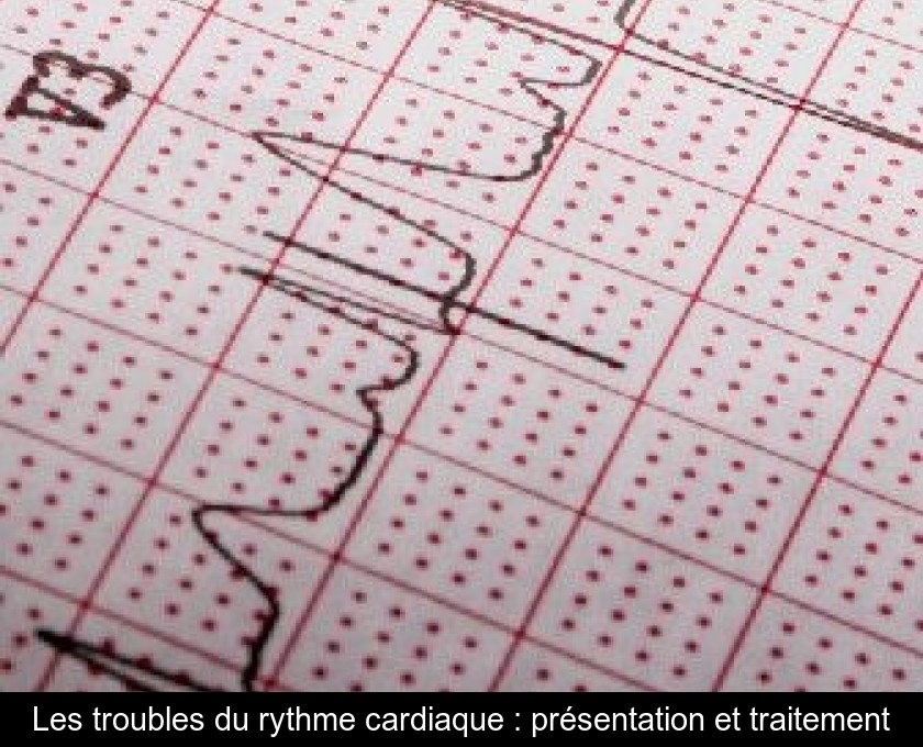 Les troubles du rythme cardiaque : présentation et traitement Les troubles du rythme cardiaque : présentation et traitement