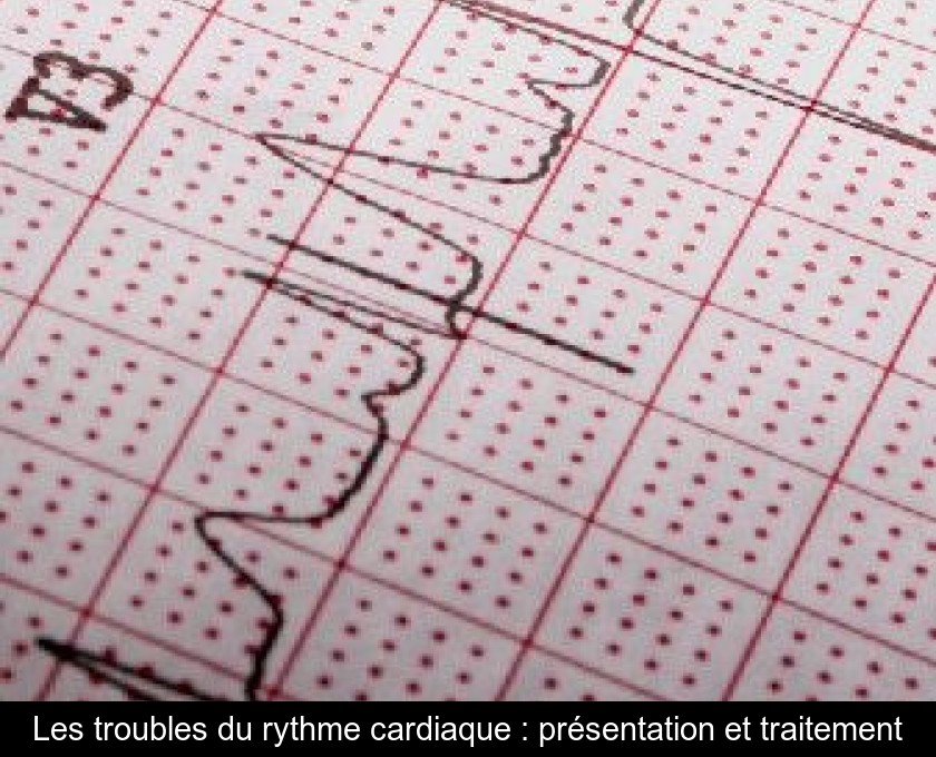 Les troubles du rythme cardiaque : présentation et traitement