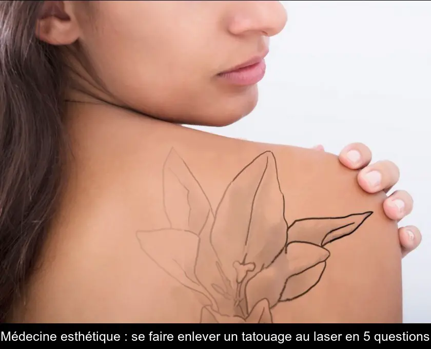 Médecine esthétique : se faire enlever un tatouage au laser en 5 questions