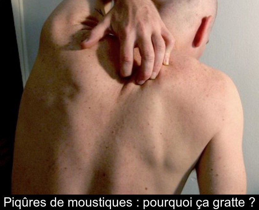 Piqûres de moustiques : pourquoi ça gratte ?