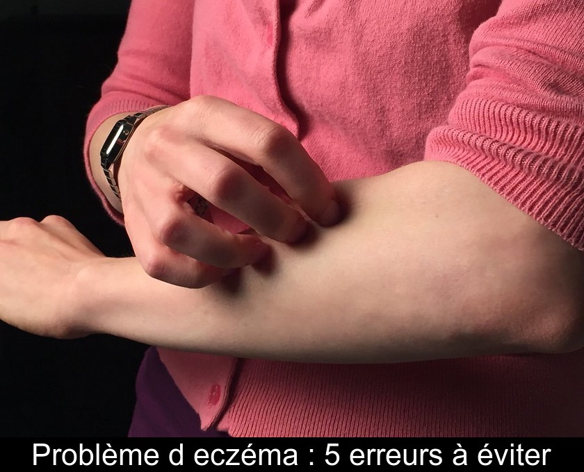 Problème d'eczéma : 5 erreurs à éviter