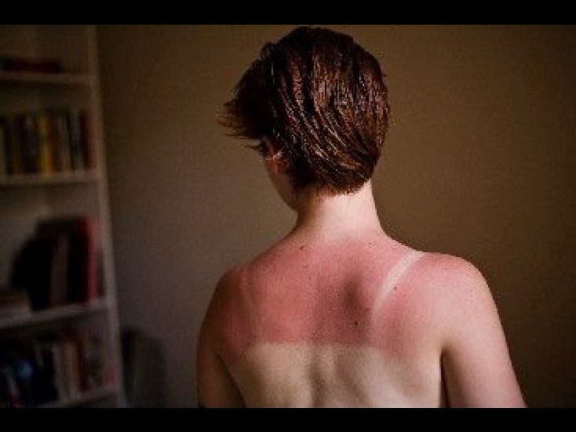Réparer un coup de soleil : conseils et astuces Réparer un coup de soleil : conseils et astuces