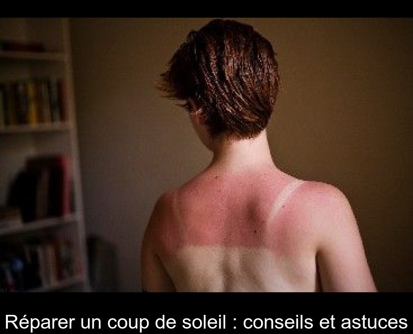 Réparer un coup de soleil : conseils et astuces