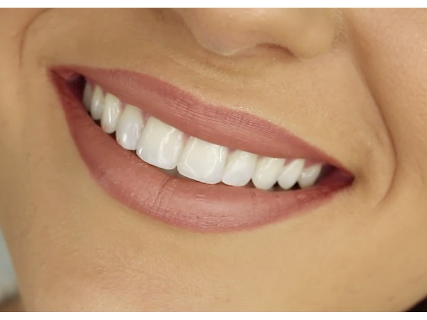 Santé : 5 astuces contre la gingivite Santé : 5 astuces contre la gingivite