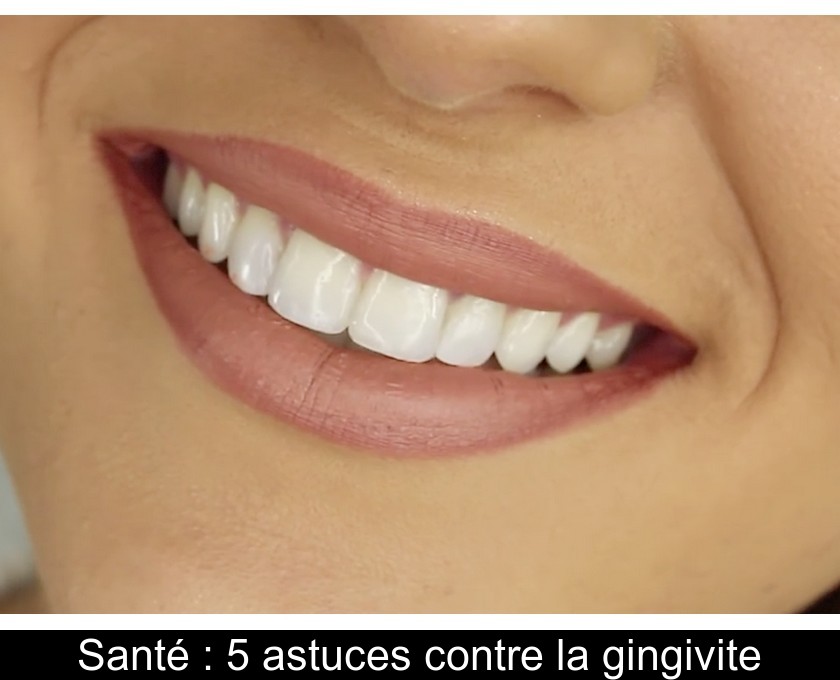 Santé : 5 astuces contre la gingivite Santé : 5 astuces contre la gingivite