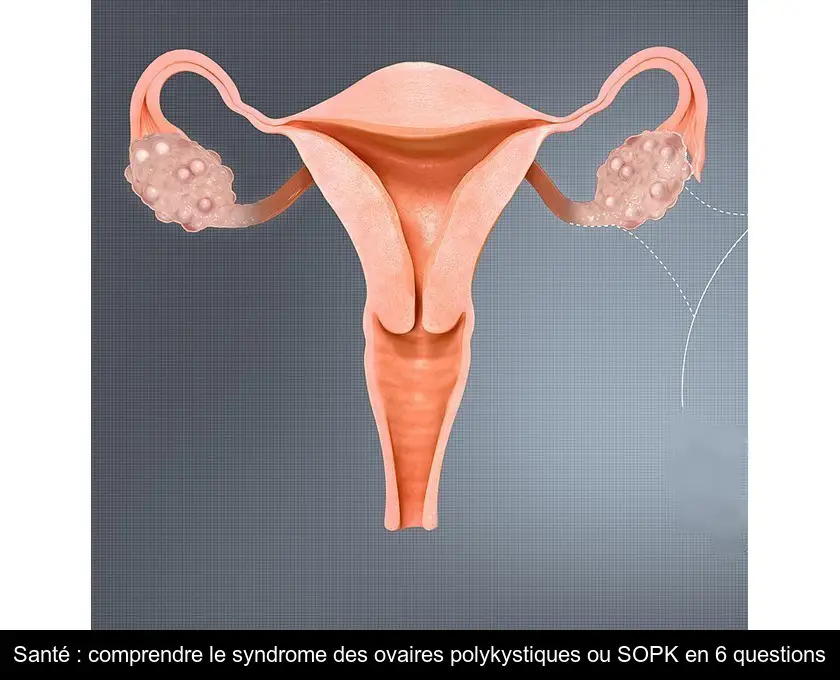 Santé : comprendre le syndrome des ovaires polykystiques ou SOPK en 6 questions