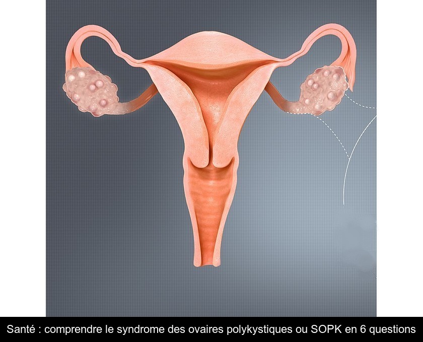 SOPK : Les 4 types du syndrome des ovaires polykystiques