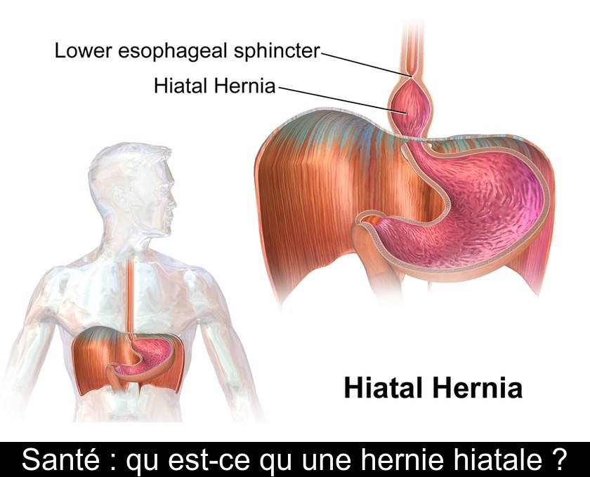 Santé : qu'est-ce qu'une hernie hiatale ?