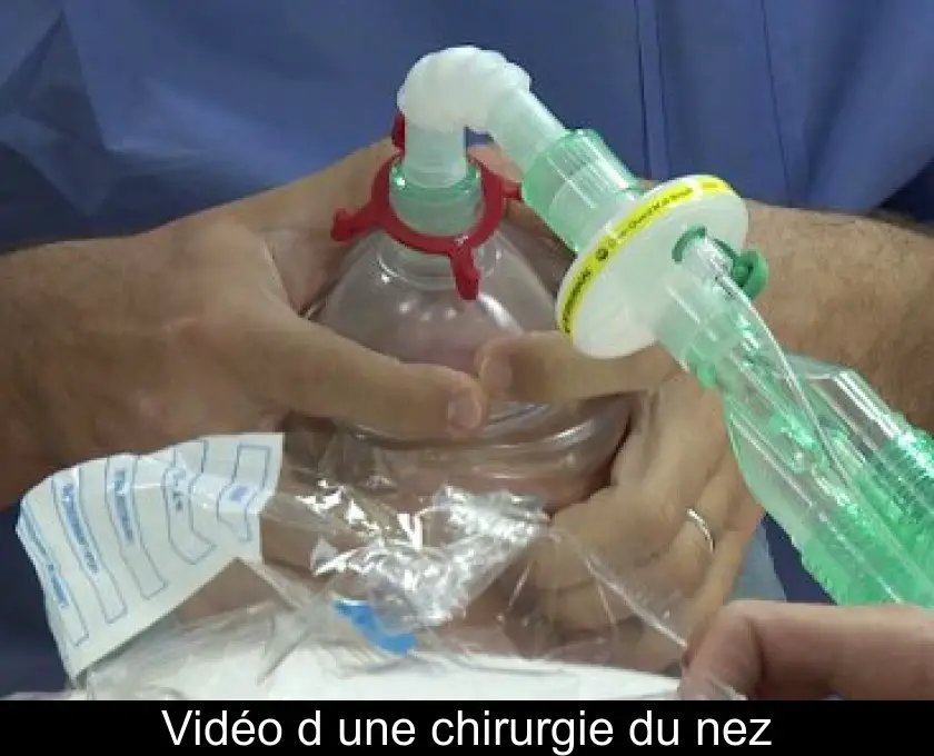 Vidéo d'une chirurgie du nez