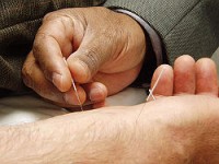 Acupuncture