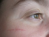 Cicatrice : comment la soigner et la faire disparaître ?