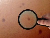 Derm Assist : l'application Google qui vous aide à détecter les cancers de la peau