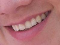 Gencives sensibles : causes et solutions