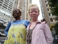 L'albinisme en 5 questions