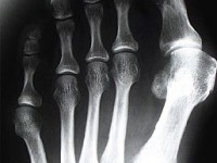 L'hallux valgus : présentation et traitement