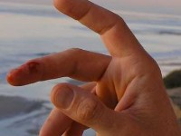 L'hémophilie : présentation, symptômes et traitements