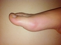 La goutte : halte aux idées reçues !