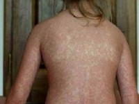 La rougeole : présentation, symptômes et prévention