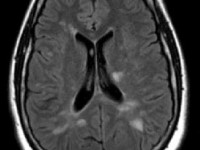 La sclérose en plaques : symptômes et traitements
