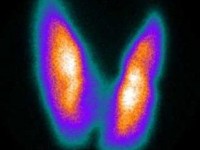 La thyroïde : présentation, troubles thyroïdiens et dépistage