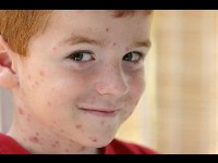 La varicelle : une maladie infantile contagieuse