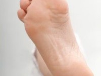 La verrue plantaire : présentation et traitements