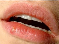 Le bouton de fièvre : causes et traitement