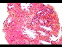 Le cancer de la prostate : diagnostic et traitements