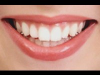 Le détartrage des dents : un geste de santé et de beauté