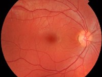 Le fond d'oeil : présentation et déroulement