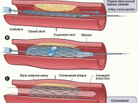 Le stent : comment ça marche ?