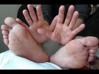 Le syndrome pieds mains bouche : symptômes et traitement