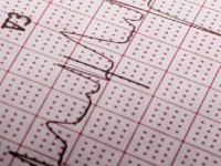 Les troubles du rythme cardiaque : présentation et traitement