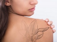 Médecine esthétique : se faire enlever un tatouage au laser en 5 questions