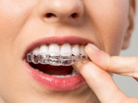 Orthodontie adulte : 7 choses à savoir sur les gouttières dentaires invisibles