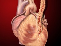 Qu'est-ce qu'un pontage coronarien ?