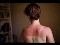 Réparer un coup de soleil : conseils et astuces