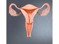 Santé : comprendre le syndrome des ovaires polykystiques ou SOPK en 6 questions