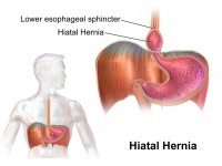 Santé : qu'est-ce qu'une hernie hiatale ?