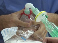 Vidéo d'une chirurgie du nez